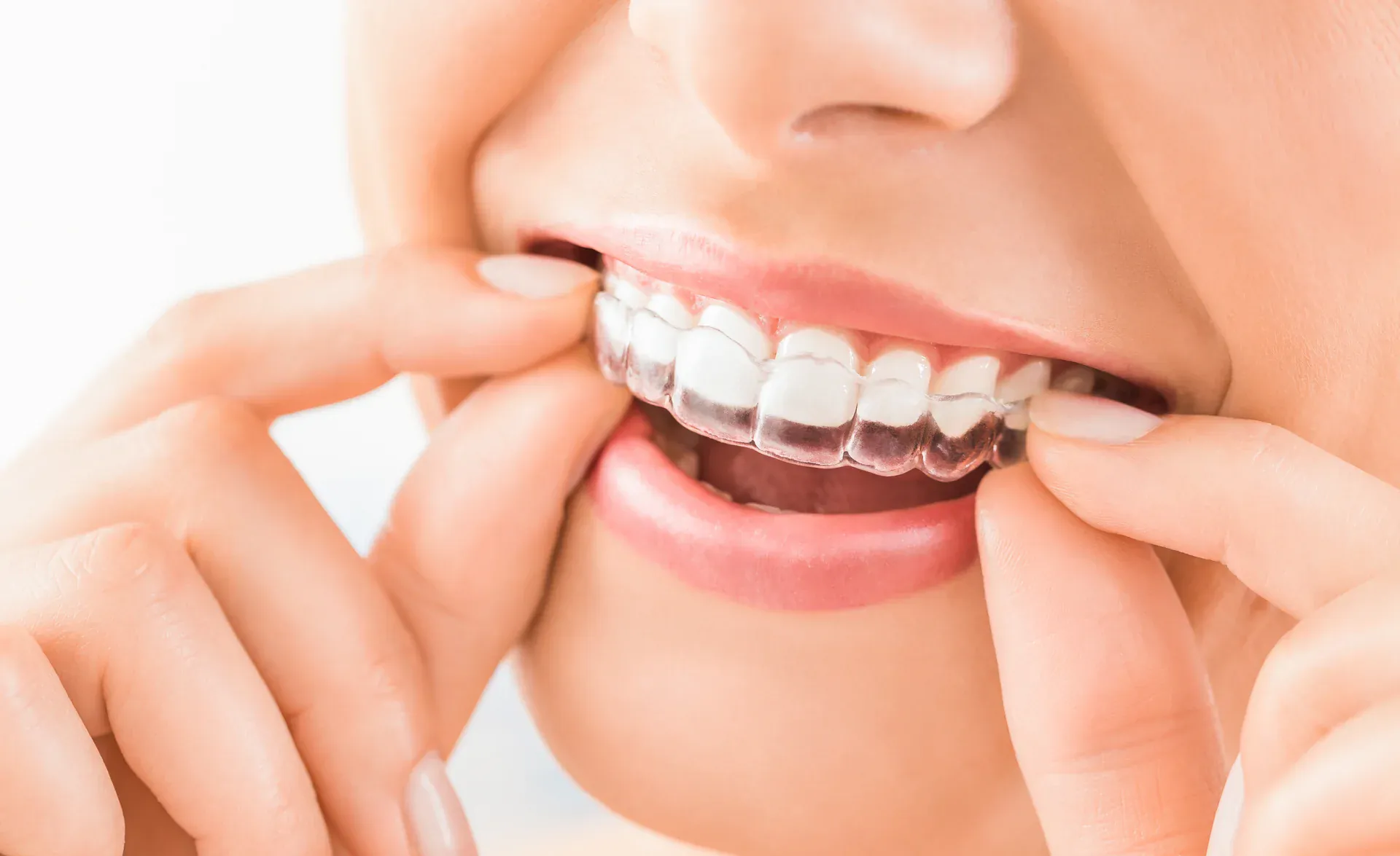Woman placing a clear aligner on her upper teeth