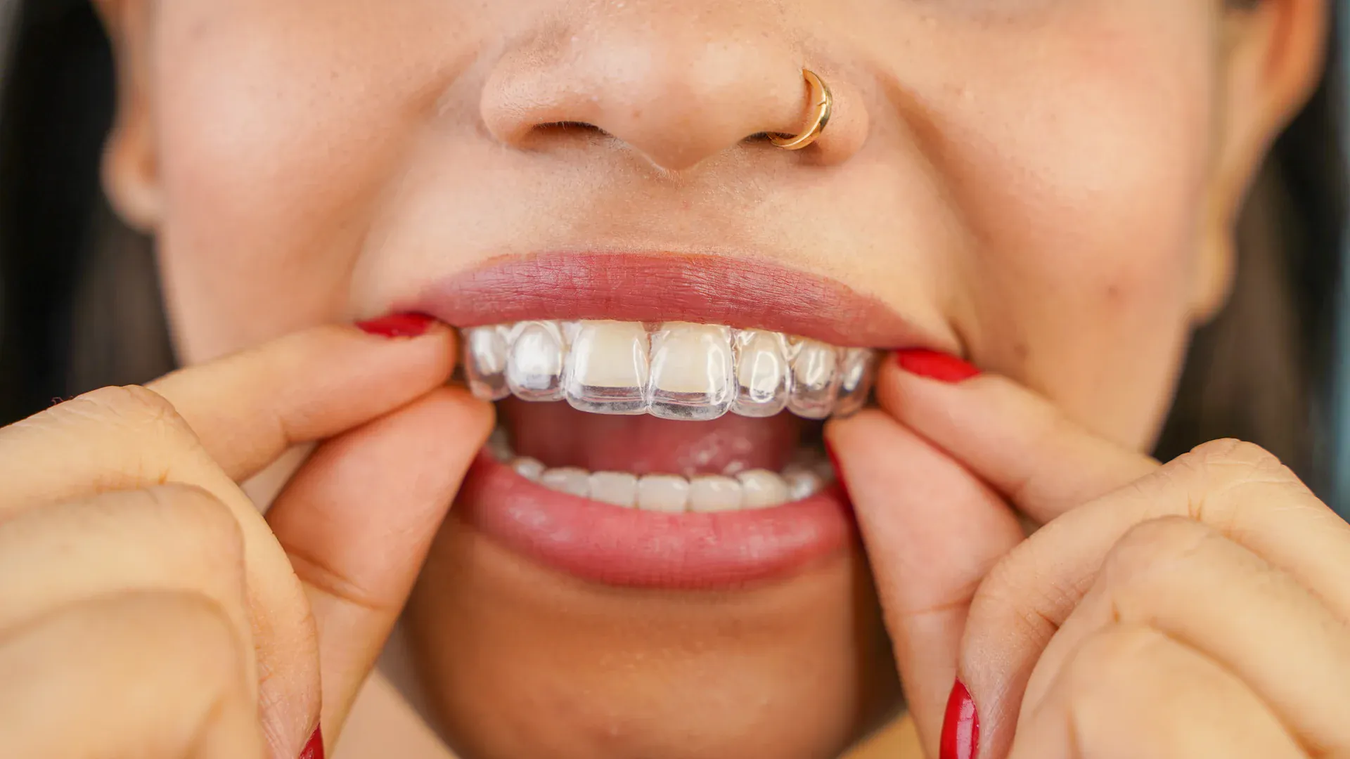 Woman placing a clear aligner over her front teeth