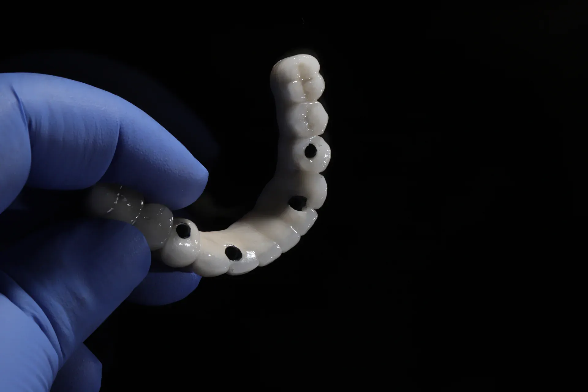 Full-arch All-on-4 dental implant bridge held by gloved hand