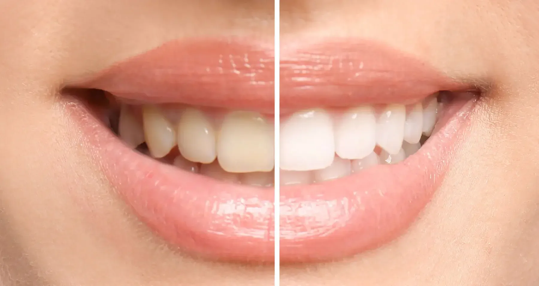 Professional Teeth Whitening in El Dorado Hills, CA