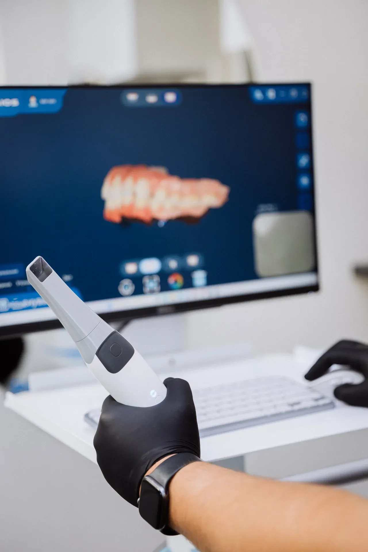 iTero digital impression scanner with 3D tooth model on screen