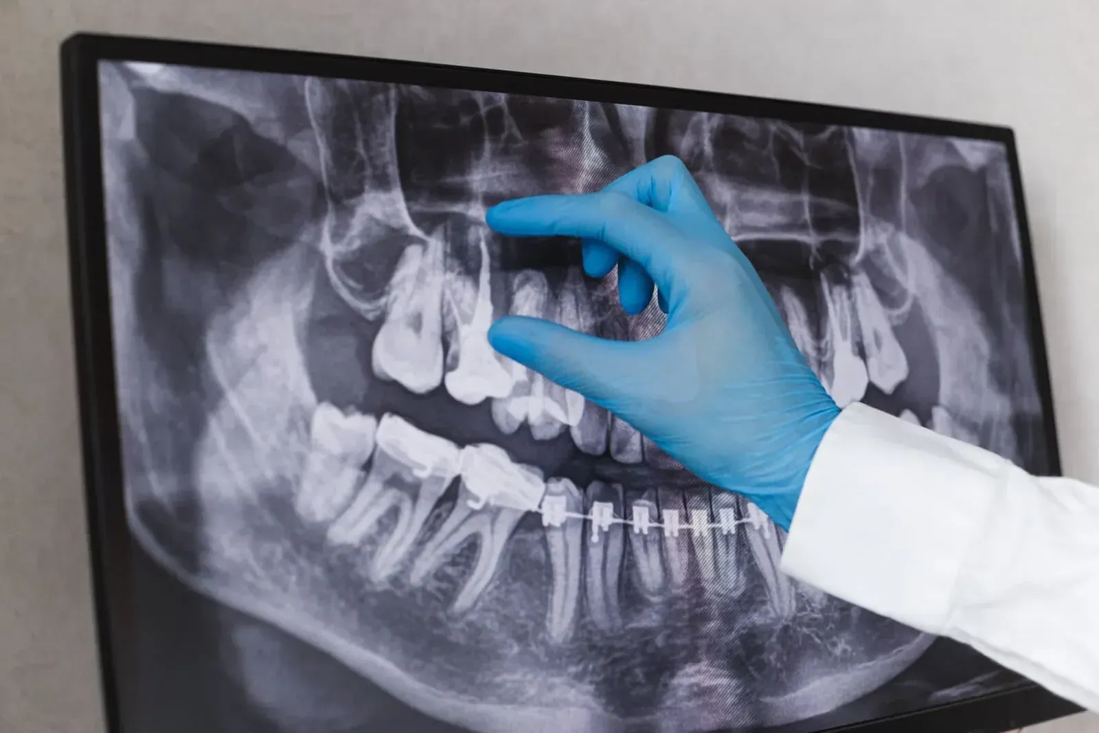 Root Canals & Endodontics