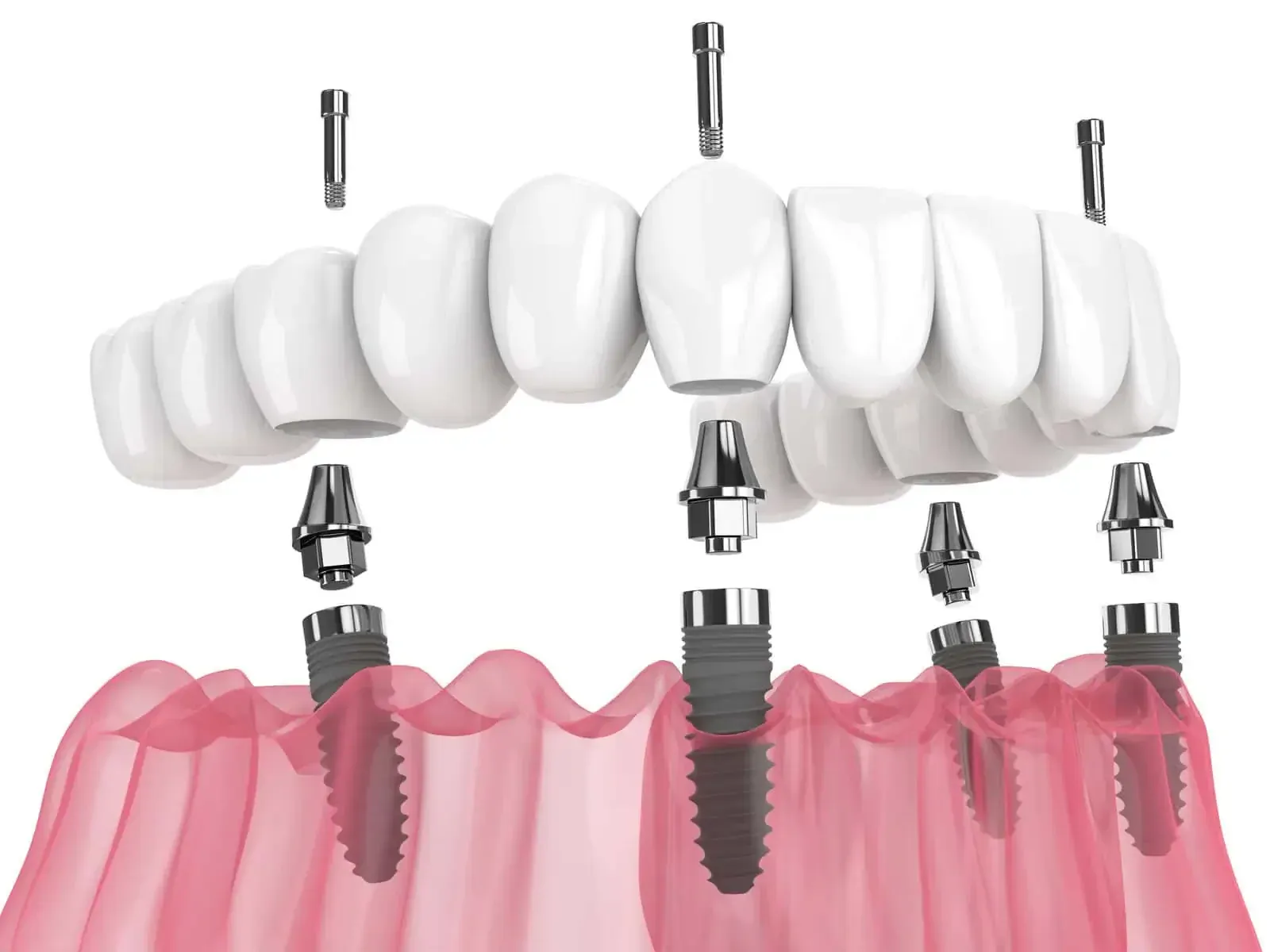 All-on-4 / Full-Arch Implants