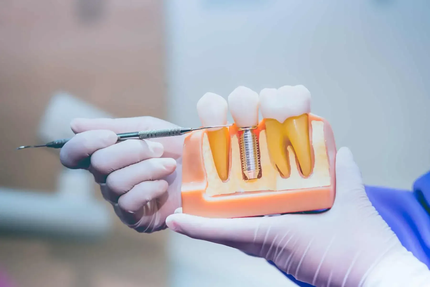 Dental Implant Cost / FAQs