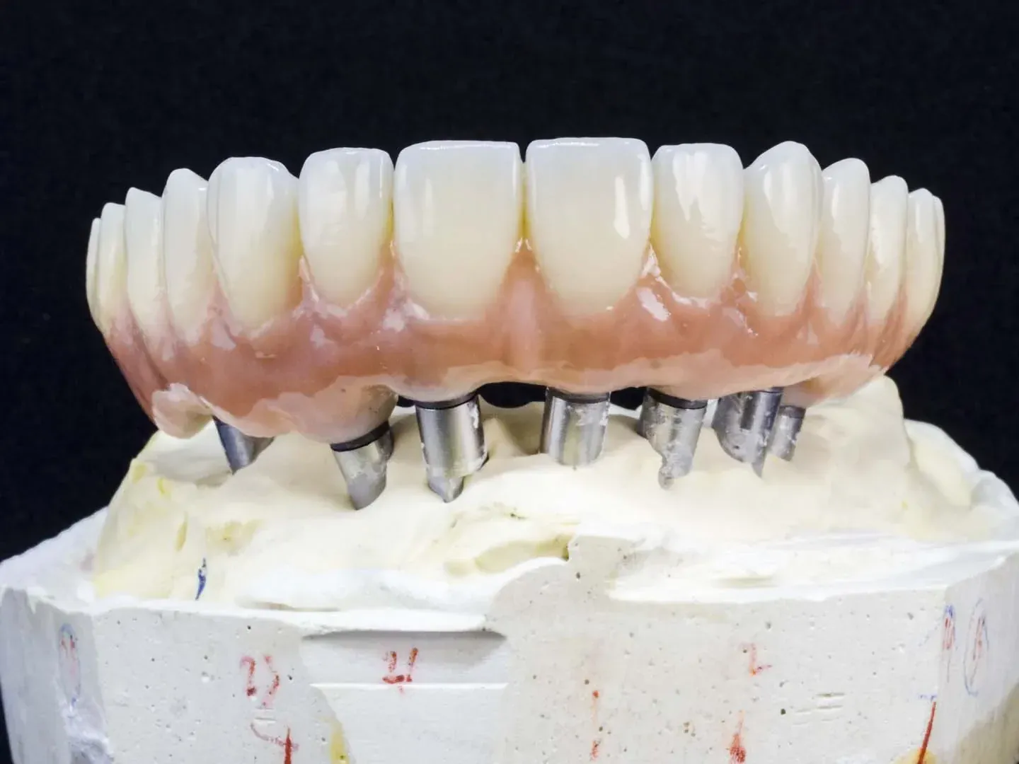 Snap-In Implant Dentures