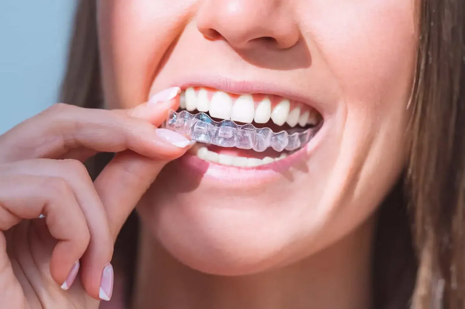 Your Invisalign FAQs Answered in El Dorado Hills