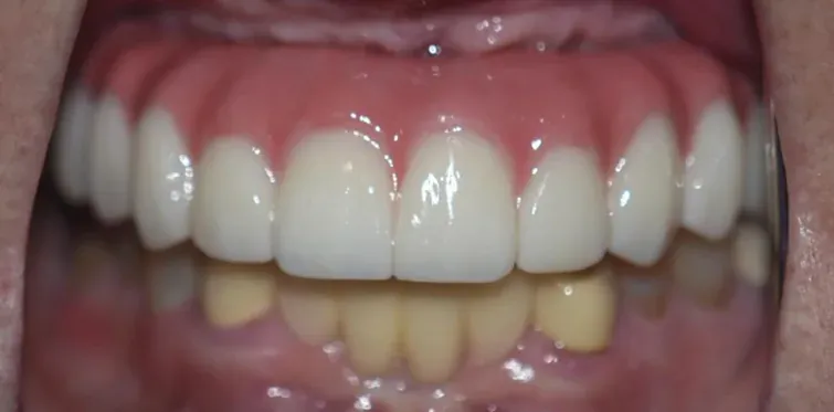 After braces