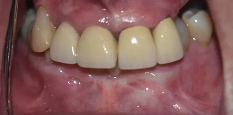 Before braces