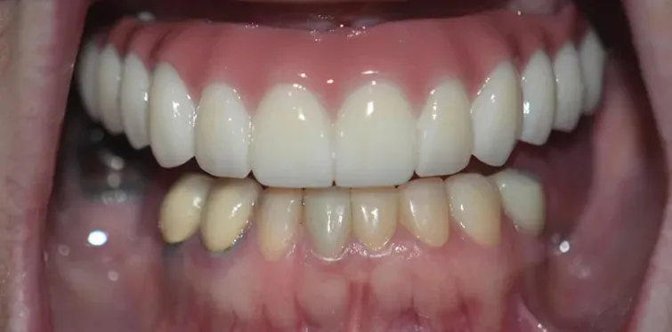 After clear aligners