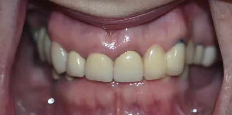 Before clear aligners