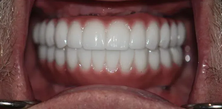 After dental implants