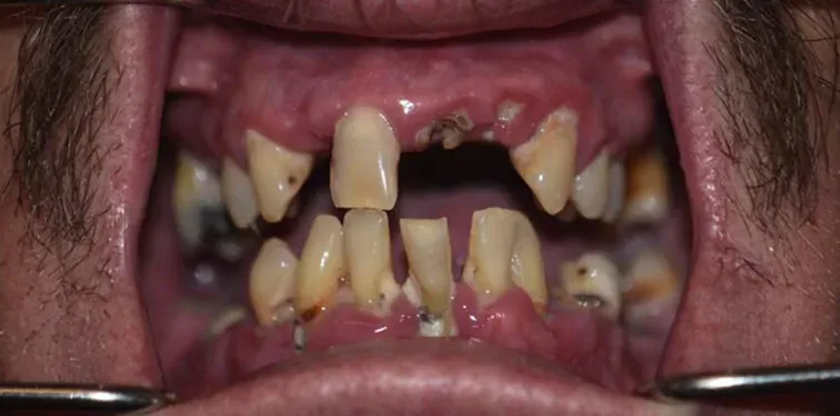 Before dental implants