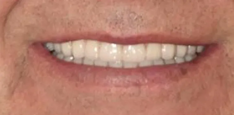 After Invisalign
