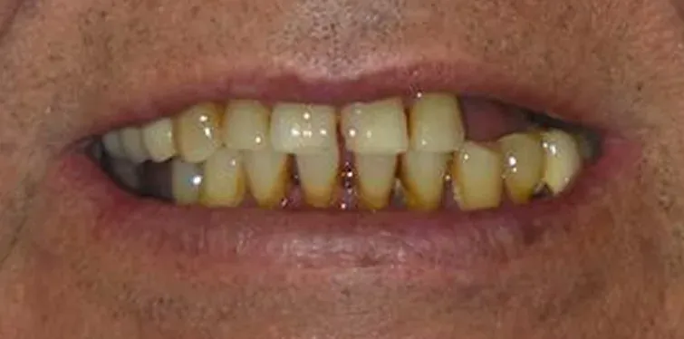 Before Invisalign