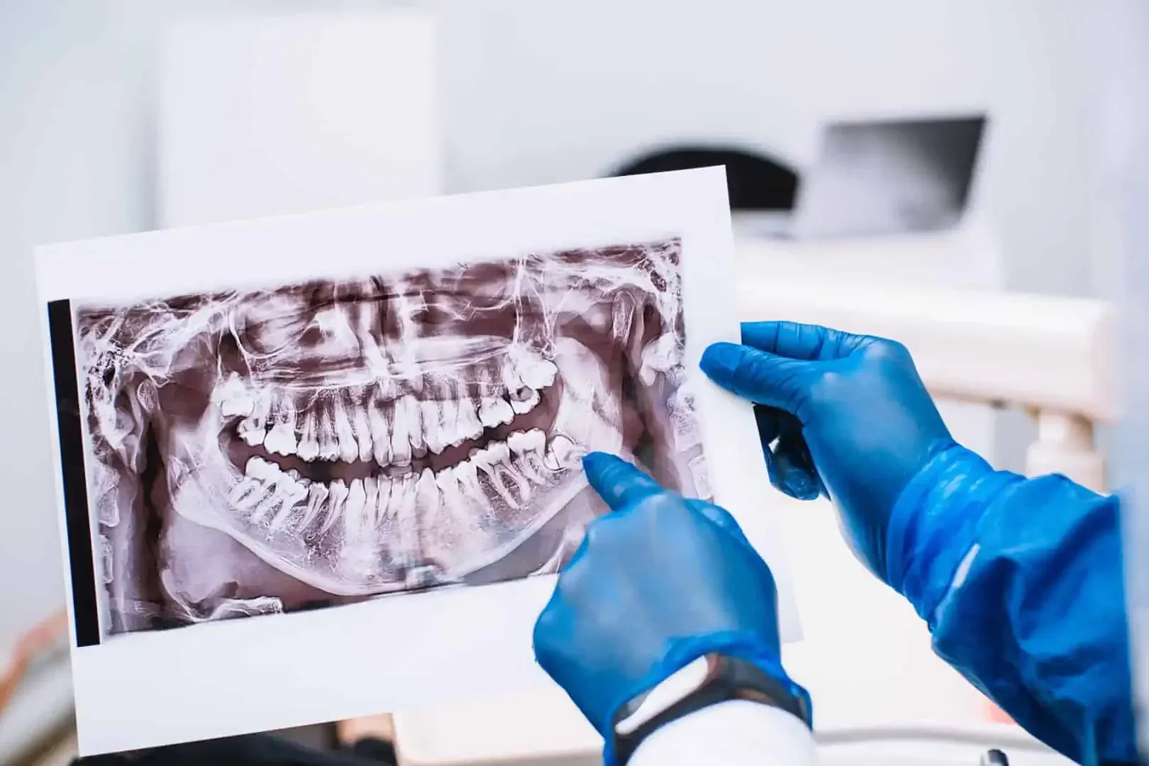 Wisdom Teeth Removal